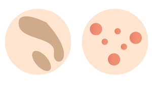 Skin Discolouration